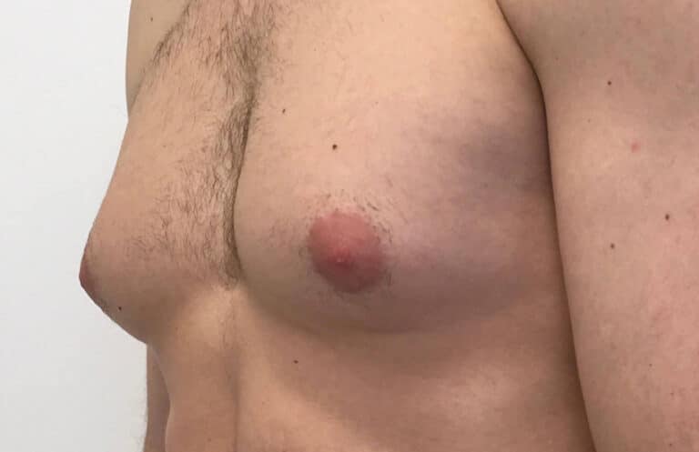 Breast formation in men: causes and treatment